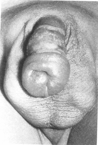 plastibell circumcision infections